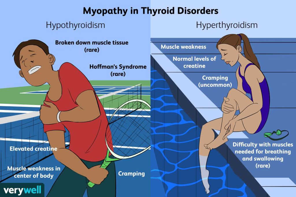 Thryoid dysfunction or Fibromyalgia?