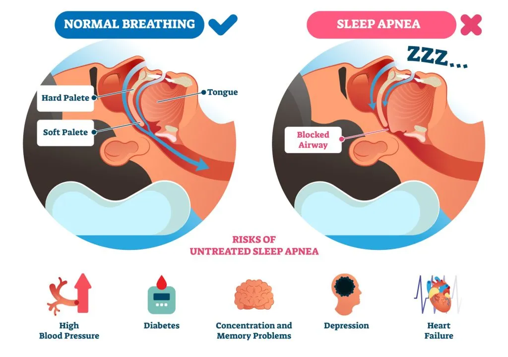 Sleep Apnea Resolved with Sound Frequencies